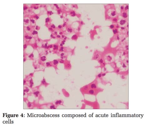 Cutaneous Chromoblastomycosis: A Case Report