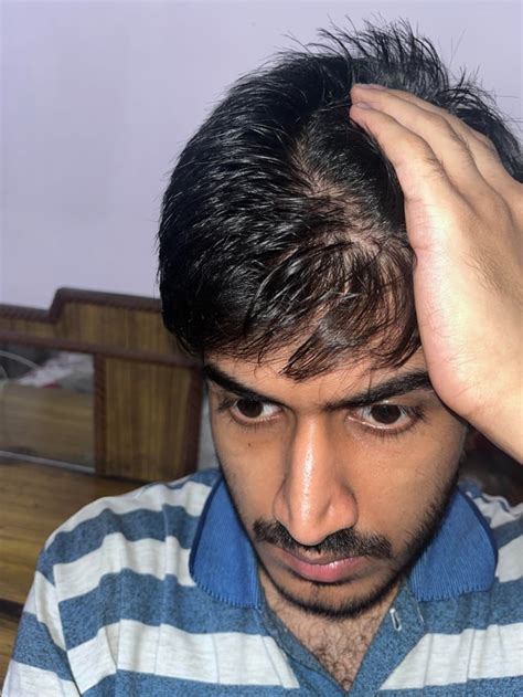 Normal Hair Density 的图像结果