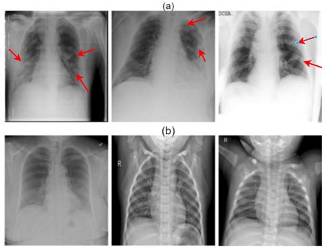 Chest X Ray Double Pneumonia