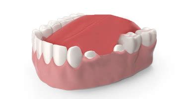 Dental Crowns and Dental Bridges Treatment
