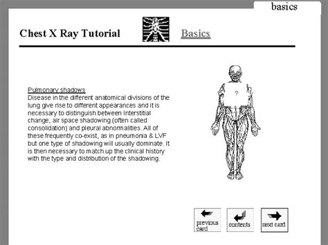 Image result for Chest X-Ray Tutorial
