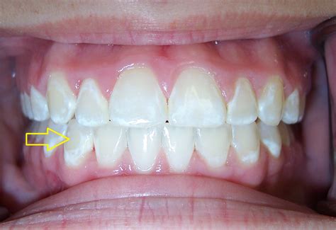 White Spots On Gums Under Teeth at Tyler Mckinley blog