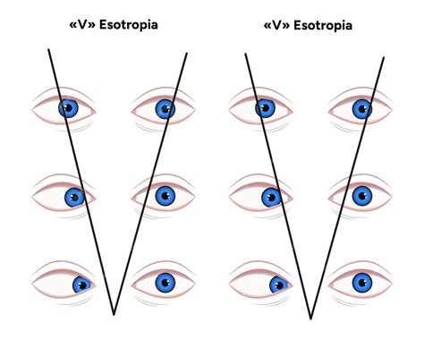 Premium Vector | Types of strabismus v esotropia and v exotropia