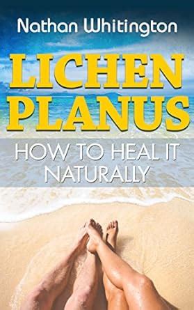Lichen Planus, How to Heal it Naturally eBook : Whitington, Nathan ...