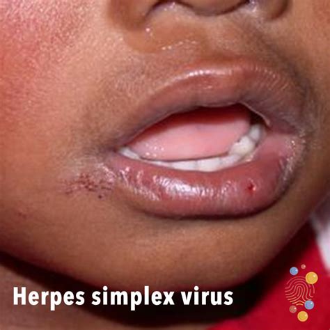 What Does Herpes Look Like Lips at Mattie Delgado blog