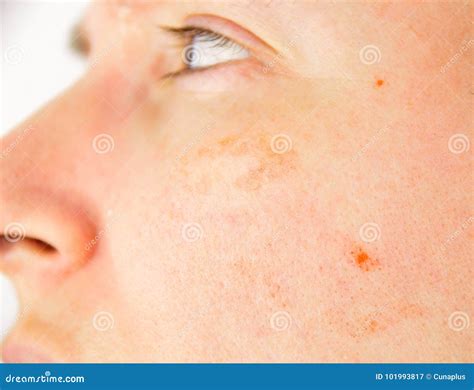 Skin of Woman with Blemish and Spots Stock Image - Image of dermatology ...