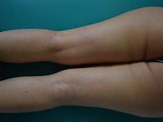 rottura vasi capillari capillari rotti nelle gambe cura della pelle rottura vasi capillari capillari rotti nelle gambe cura della pelle