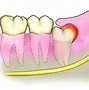 Image result for 智齿 a wisdom tooth