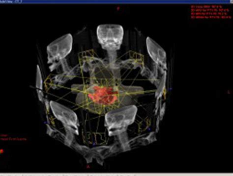Radiotherapy | Targeting Cancer