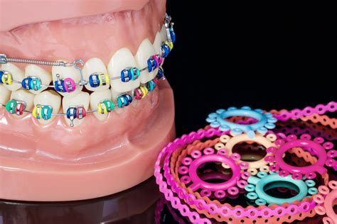 Exploring Brace Types: A Comprehensive Guide