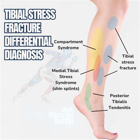 A Complete Guide to Bone Stress Injury in Runners — The Run Rx