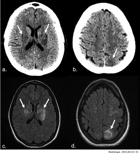 Tomografia En Ingles