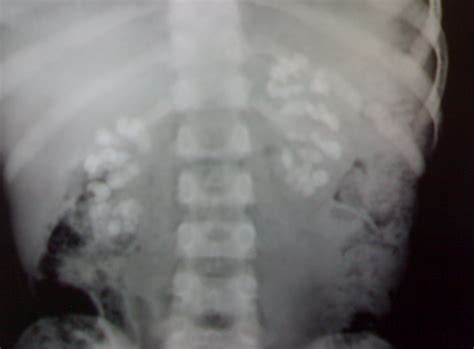 Distal renal tubular acidosis with nephrocalcinosis | Pediatric Oncall ...