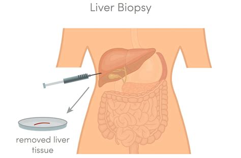 How Liver Biopsy Done