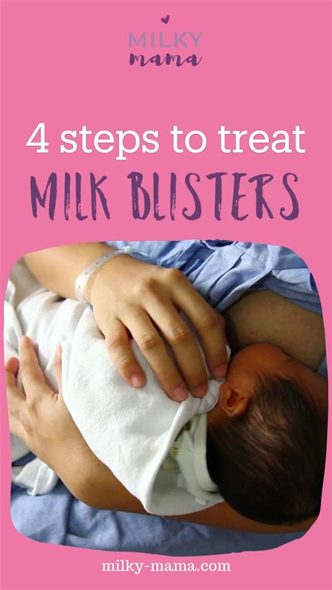 Milk blister 11 best remedies plus causes and prevention – Artofit