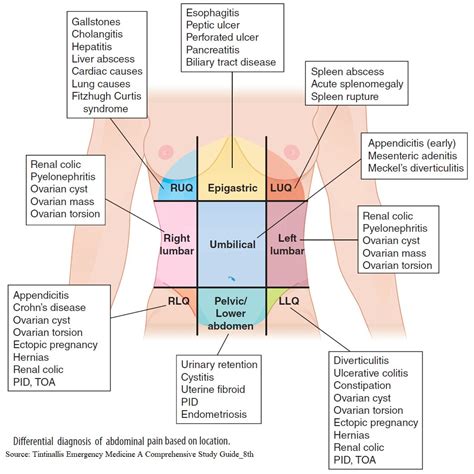 Appendicitis Pain Location Diagram