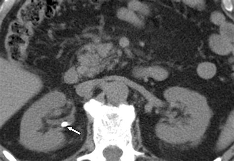 Kidney Stone Ct Wikidoc LASER LITHOTRIPSY FOR KIDNEY STONES KELINA ...