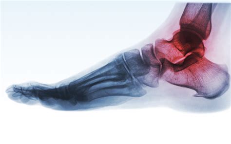 Foot & Ankle Sprains | Dr Niks Foot & Ankle Center