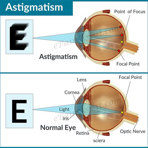 Astigmatism|Causes|Types|Symptoms|Treatment: Lenses, Refractive Surgery