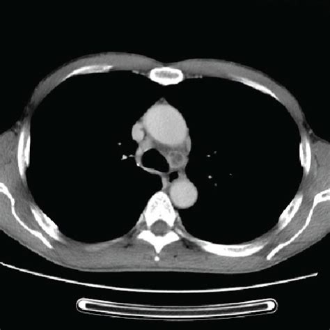 Chest CT scan. Chest CT scan performed on admission (a, b) four months ...