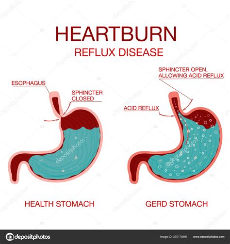 Stomach Pain Causing Heartburn at Jai Reading blog