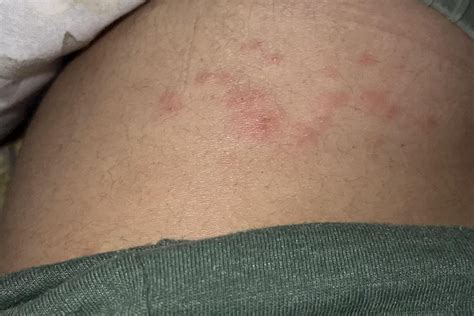 itchy red bumps on hip/back : r/DermatologyQuestions