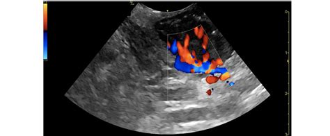 Guide on POCUS for PTA — USF Emergency Medicine