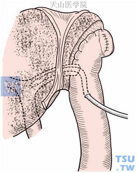 【图】肝内胆管空肠吻合术 - 外科手术学 - 天山医学院