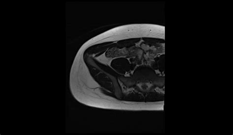 Image result for Normal Appendix MRI