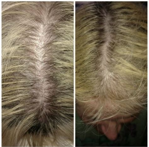 PRP Hair Restoration | Aestique Medi Spa