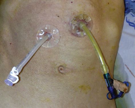 Percutaneous Endoscopic Gastrostomy And Jejunostomy at Helen Williamson blog