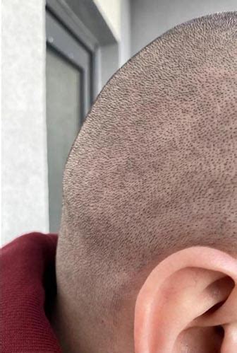 Scalp Micropigmentation (SMP) Cost Delhi India Artist Studio