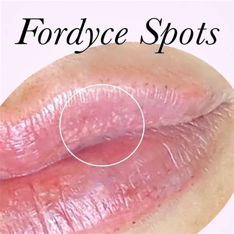 Fordyce Spots On Lips