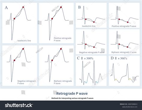 Atrial Depolarization