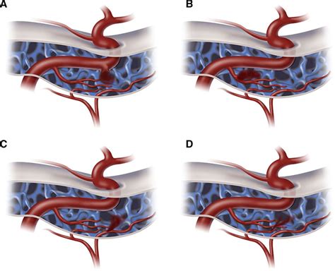 Intracranial Dural Arteriovenous Fistulae | Stroke