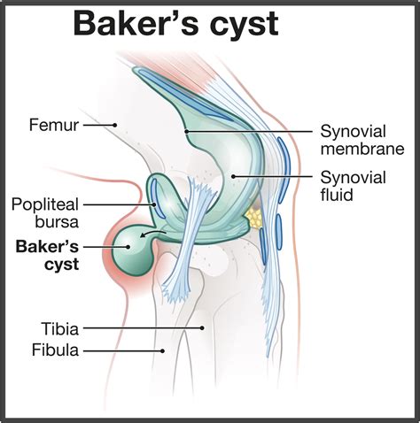 Rice For Baker's Cyst