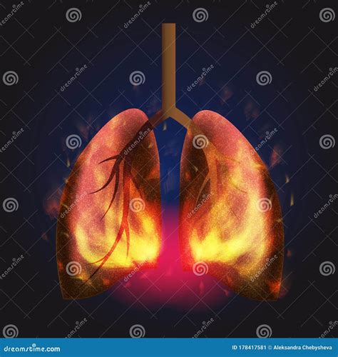 Burning Lungs from a Virus COVID-19 Coronavirus, Burns Lungs, Tuberculosis, Pneumonia Editorial ...