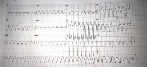 The daily educational pearl – VT vs SVT with aberrancy | Emergucate