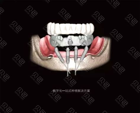 韩国种植牙和德国种植牙的区别有哪些?哪个种植牙更好? - 贝色口腔