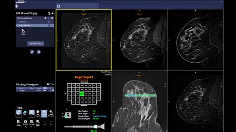 Breast MRI - Siemens Healthineers USA