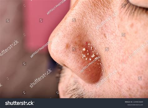 Image result for Cyst Extraction Videos