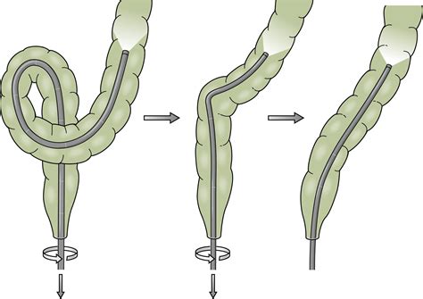 Image result for Colonoscopy Sigma Loop