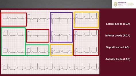 Lateral Leads Of Ecg