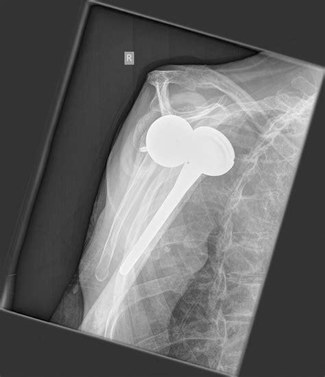 X Ray Of Reverse Total Shoulder Replacement at Jaclyn Glenn blog