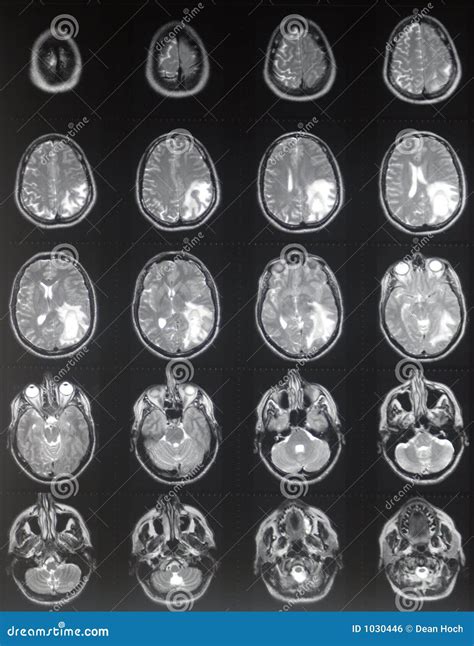 What Does A Tumor Look Like On An Mri at Kimberly Knox blog