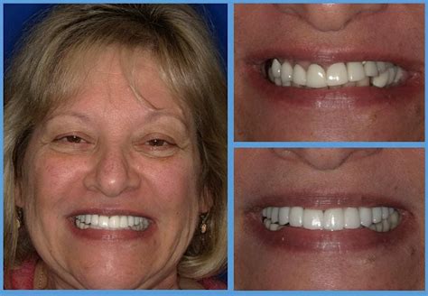 ExoCAD/Digital Smile Design/Digital Workflows for the Comprehensive ...