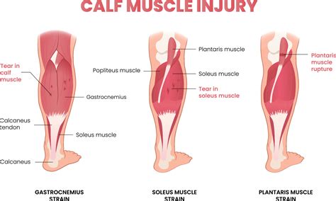 calf muscle injury infographic 21432411 Vector Art at Vecteezy