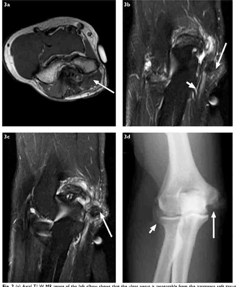 Gouty Arthritis Elbow Radiology at Ava Lazarev blog