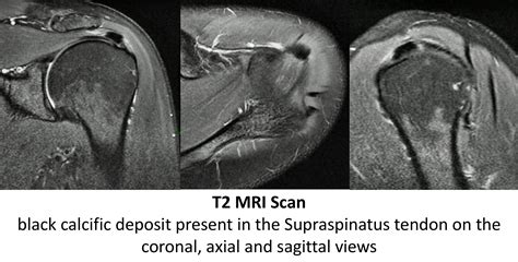 Shoulder Calcification