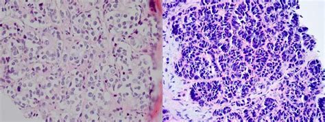 Aggressive Prostate Cancer Subtype More Common Than Expected - NCI